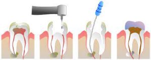 Endodontics Services
